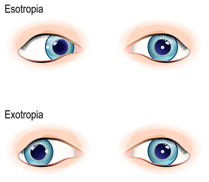 diagram showing esotropia and exotropia strabismus