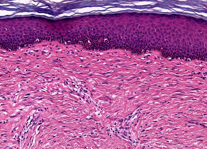 microscope view of scar tissue