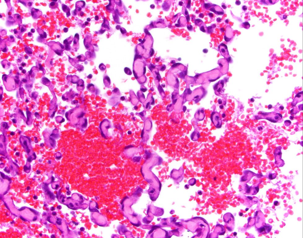 microscopic view of hemangiosarcoma tumor cells