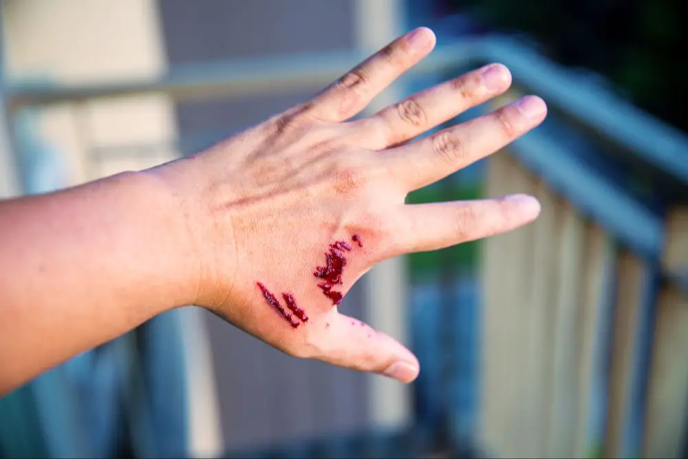 person checking dog bite on hand