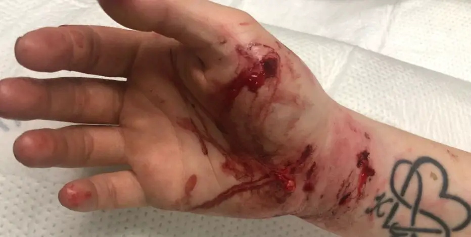 person examining dog bite on hand