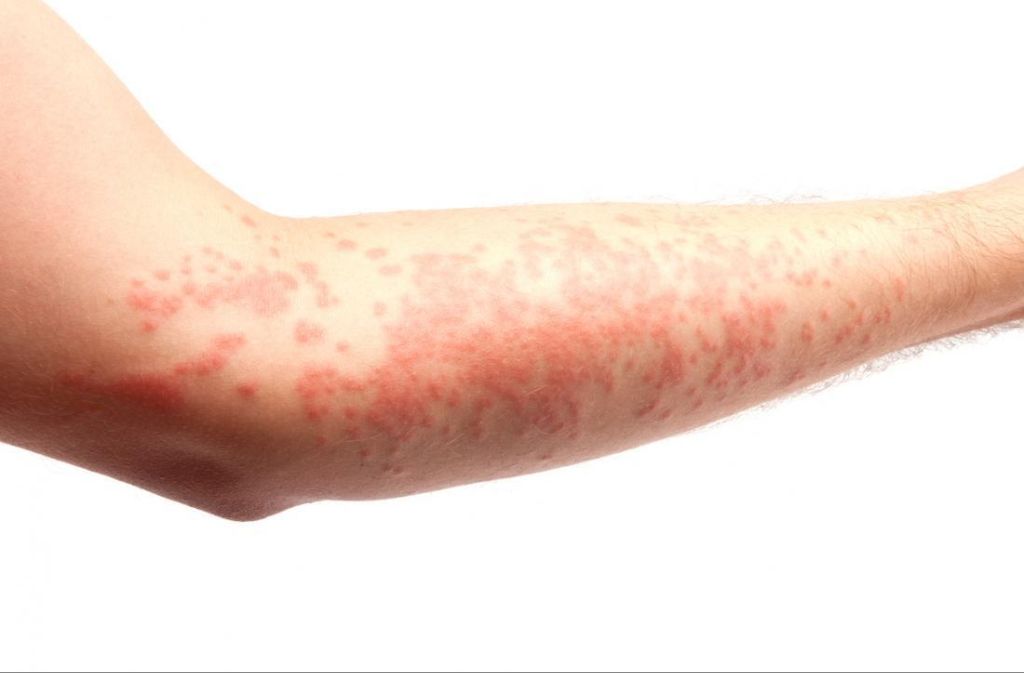 red raised hives rash on human skin