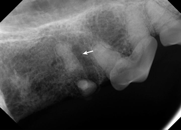 x-ray showing broken tooth root fragment